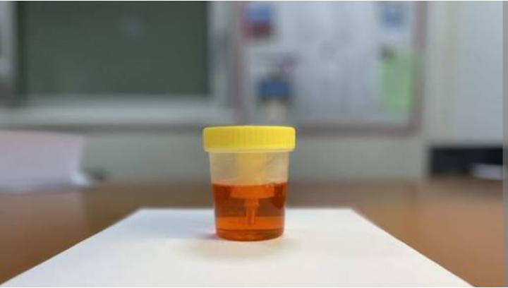 Urine anormale compostée